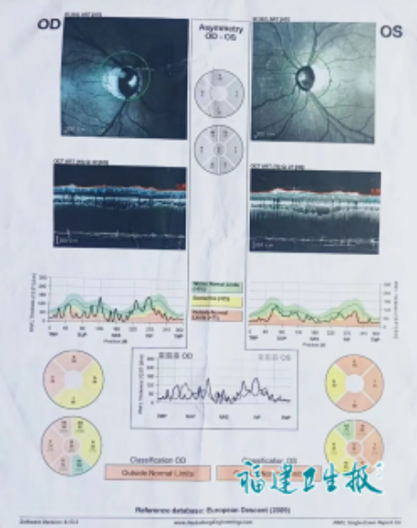  【眼科学警示】激素类眼药水的致命陷阱：一个被忽视的用药盲区 健康养生